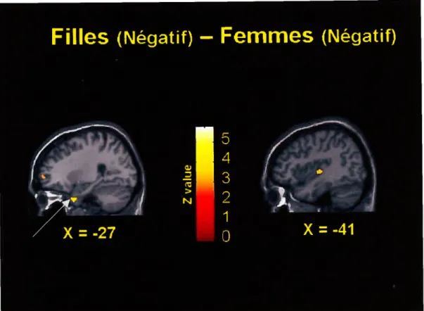 Figure 10 Activations significatives lors de la comparaison entre la reconnaissance des stimuli négatifs chez les filles et les femmes.