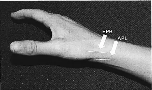 Figure 1 Localisation des tendons abductor pollicis longus et extensor