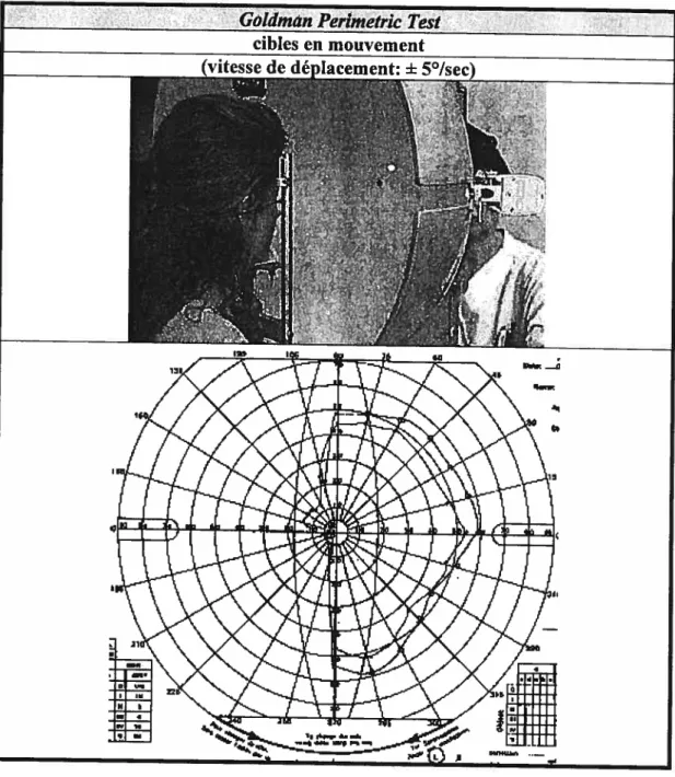 FIGURE 5: Aperçu du test de Goidman utilisé pour mesurer le champ visuel