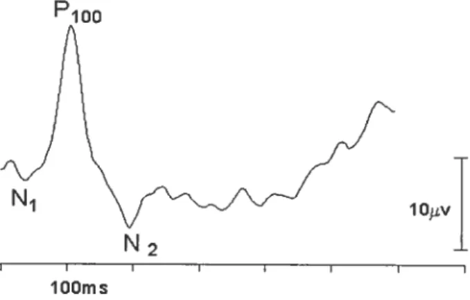 Fig. 5 Exemple d’un potentiel évoqué visuel (PEV) au mouvement, enregistré à Dz chez un sujet normal.