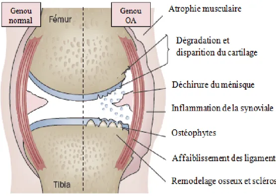 Figure 6: Structures articulaires touchées au cours de la maladie d’OA. Comparaison  entre un genou normal et un genou  arthrosique (Adapté de (Henter, 2011)