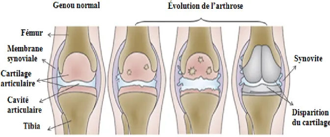 Figure 7: Étape de l’évolution de l’arthrose au niveau du genou.   Le développement de  l’OA se fait de façon progressive passant d’une OA légère à une OA avancée (Adapté de  (Cicuttini  et Wluka, 2014))