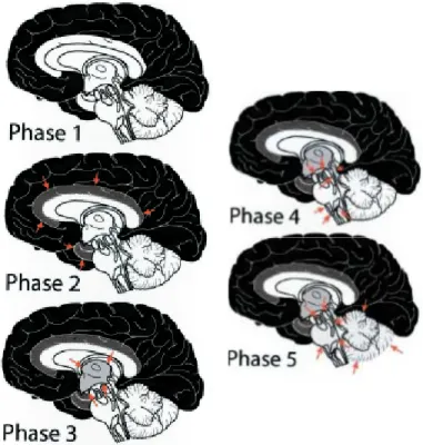 Figure 2.7 : Les cinq phases d’accumulation de l’Aβ dans la MA. Dans l’ordre, les régions  affectées du cerveau sont : phase 1, les hémisphères cérébraux (dépeints en noir); phase 2, les 