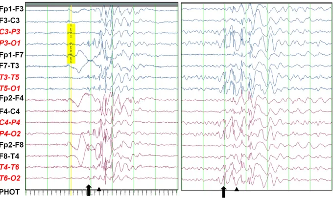Figure 5. Electroencephalographic features of patients with mutations in SYNGAP1.  Interictal  EEGs  of  patients  with  mutation  p.R579X  (left  panel)  and  p.W362R  (right  panel)  showing the typical interictal discharges observed in our epileptic patients with mutations in 