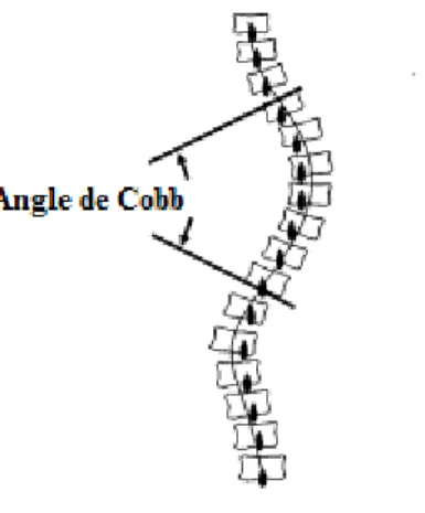 Figure 3 – L’angle de Cobb représente l’angle formé entre les lignes prolongeant le plateau supérieur de la vertèbre  limite supérieur et le plateau inférieur de la vertèbre limite inférieur [10]