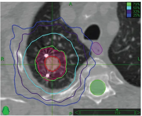 Figure 3.1 – Plan de traitement en SABR pulmonaire, (rouge) GTV, (rose) PTV, (mauve) oeso- oeso-phage et (vert) moelle épinière [59]