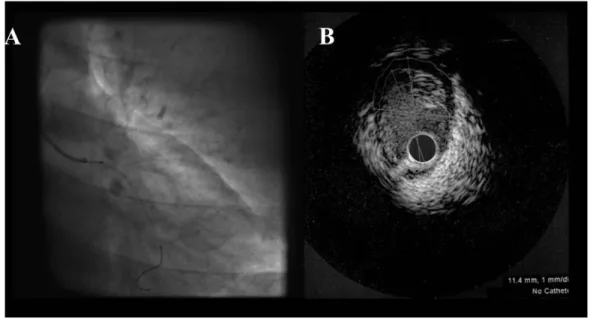 Figure 16: IVUS 