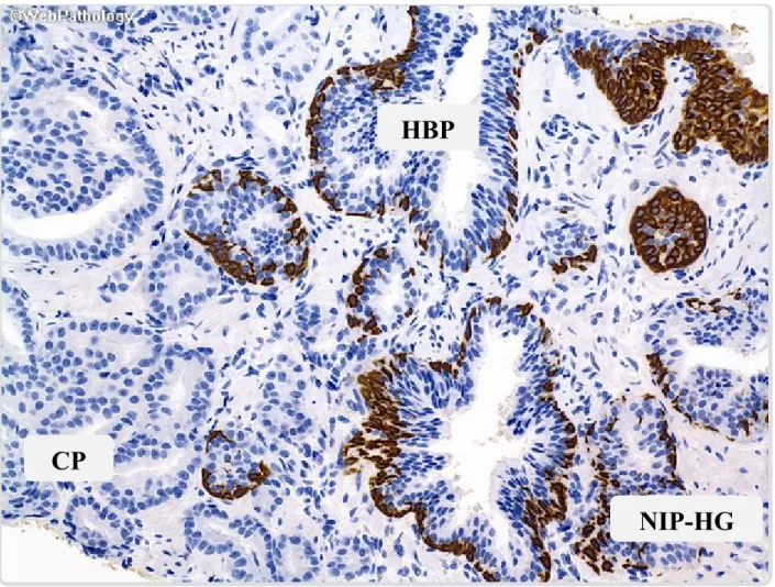 Figure  4.  Coupe  histologique  de  prostate.  Représentation  des  glandes  de  néoplasie  intra- intra-épithéliale de haut-grade (NIP-HG), de l'hypertrophie bénigne de la prostate (HBP) et du cancer  de  la  prostate  (CP)