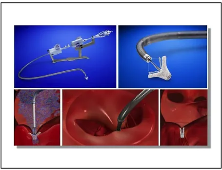 Figure  4.  Transcatheter  mitral  valve  repair  with  the  MitraClip  device  (from  top  left  to  bottom right: MitraClip device; close-up of MitraClip device; MitraClip device in place in jet  of  mitral  regurgitation;  double  orifice  mitral  valve;  MitraClip  in  place  following  device  release) (Courtesy of Abbott Vascular, Menlo Park, CA) 