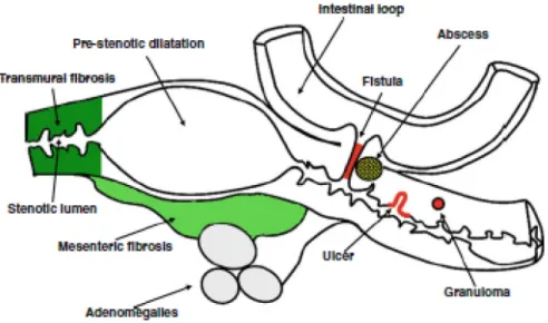 Figure 1.2. Schéma représentant les lésions et complications intestinales dans la maladie de  Crohn