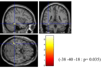 Figure 3. Désactivation significative du Précuneus. Régression du score moyen à l’échelle 