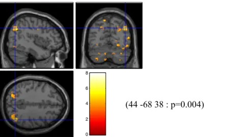 Figure 4. Désactivation significative du cortex cingulaire postérieur. Régression du score  moyen  à  l’échelle  Détresse  chronique  et  demandes  psychologiques  face  aux  stimuli  de  tristesse