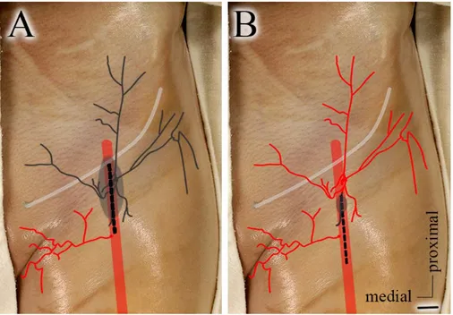 Figure 2.5: Proposition of a new approach for the vertical infrainguinal incision. 