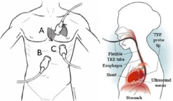 Fig. 2.3 - Transthoracic and trasesophageal echocardiography approaches. Left panel: Transthoracic echocardiography 