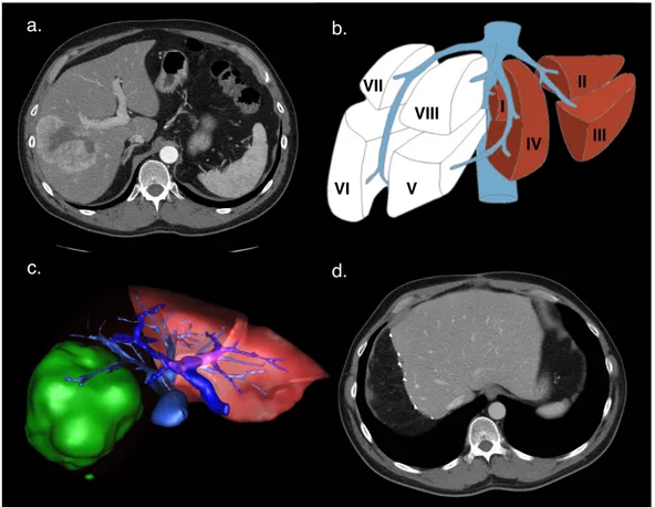 Figure 2.7: Future liver remnant volume calculation in fatty liver.  