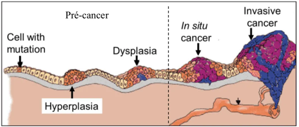 Figure  2-4  Illustration  des  différentes  étapes  d'évolution  d'un  cancer  de  la  mutation  cellulaire jusqu'au cancer invasif