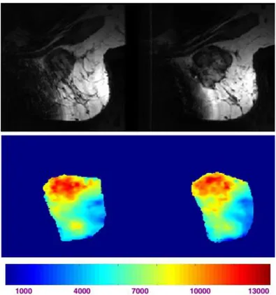 Figure 3-7 Exemples d’images IRM et cartes d’élasticité obtenues par élastographie par  résonance magnétique