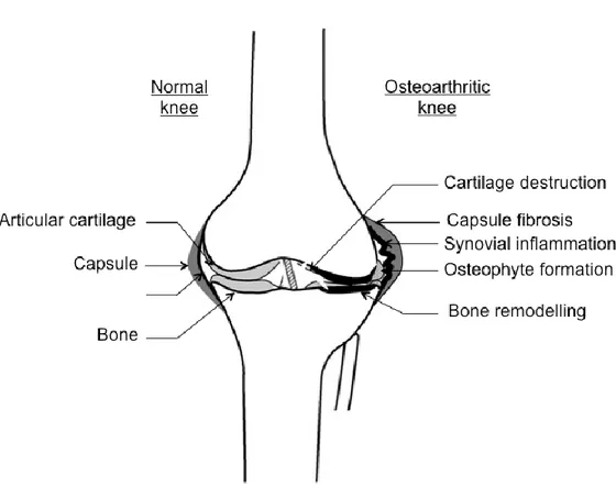 Figure 1: Schematic representation of the main constituents of a normal and osteoarthritic knee