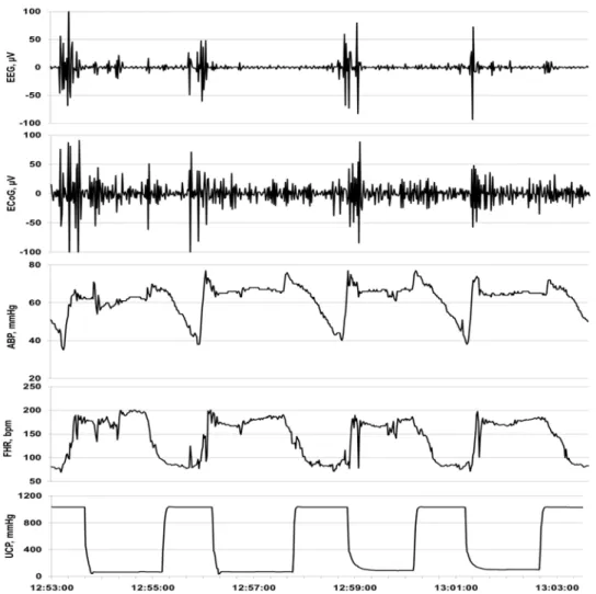 Fig. 1. Exemple d’une réponse ECOG / EEG à des OCO répétitifs. Vue de 10 min d’un patron d’un arrêt cérébral  adaptatif  visible à l’ECoG et à l’EEG en réponse aux changements de la pression artérielle sanguine (PAS) et du  rythme cardiaque fœtal (RCF)