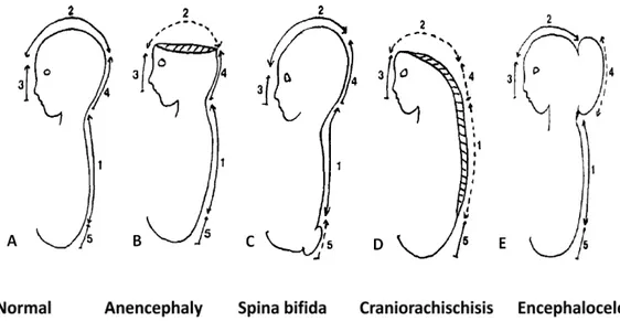 Fig. 1. Representative NTDs and their defective sites in neural tube closure. A: Normal  neural tube formation marked with 5 closure initiating sites