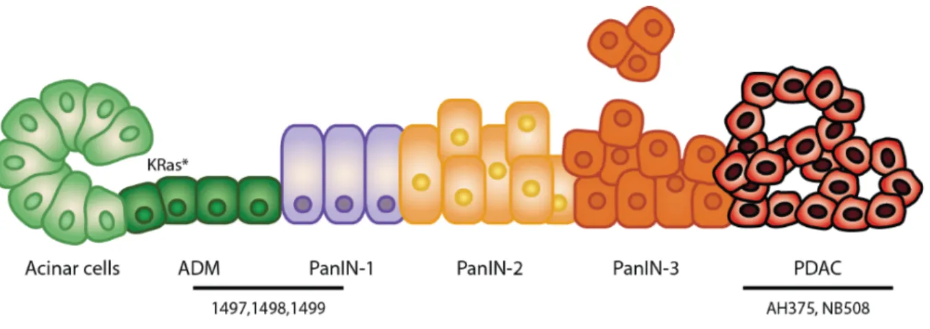 Figure 1. Schéma de la progression du cancer du pancréas. 