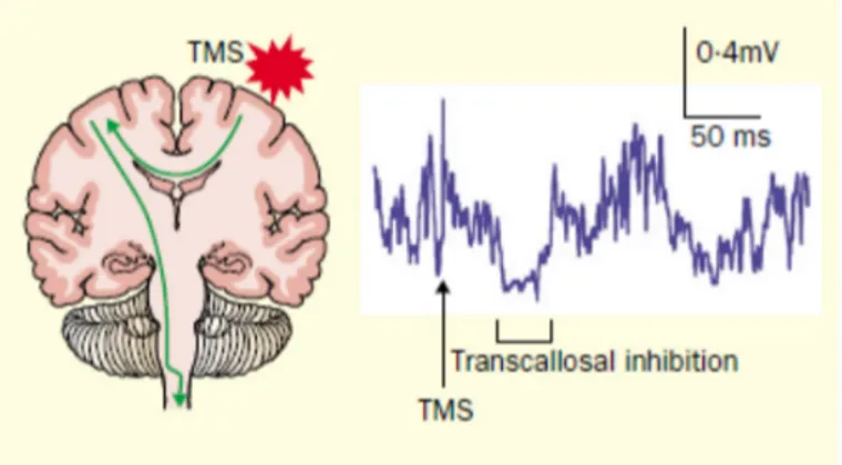 Figure 6 : Inhibition transcalleuse générée par la stimulation du cortex ipsilatéral 