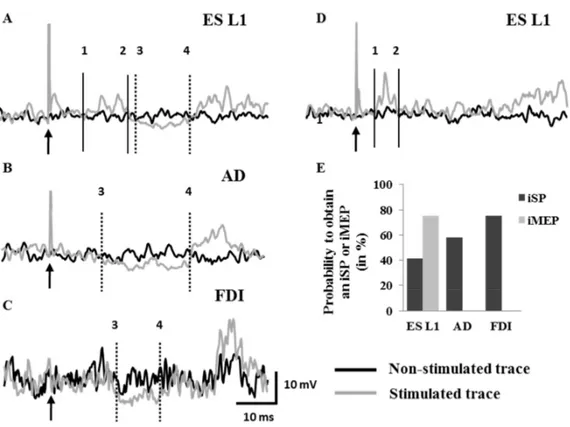 Figure 2: Ipsilateral responses induced by right motor cortex stimulation in ES L1, AD  and FDI