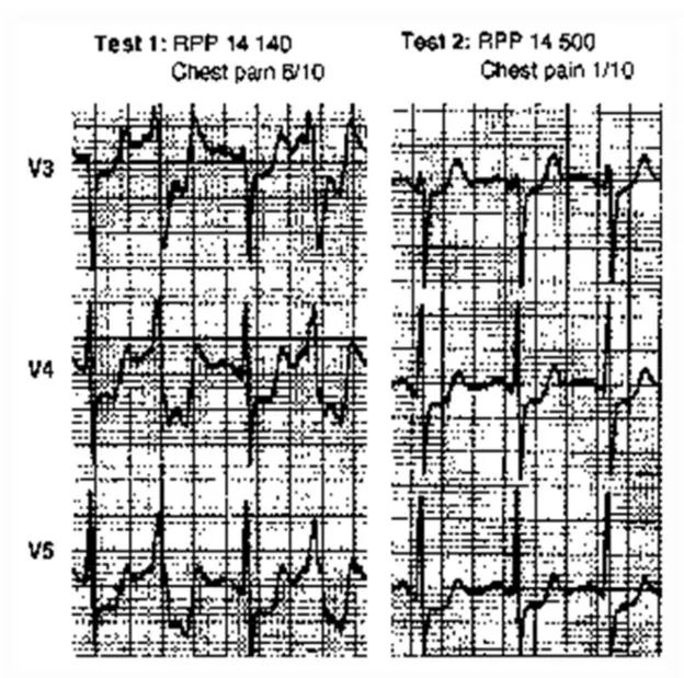 Figure  7.  Image  tirée  de MacAlpin  et  coll.  1965.  Le  test  d’effort  2  (à  droite)  est  séparé 