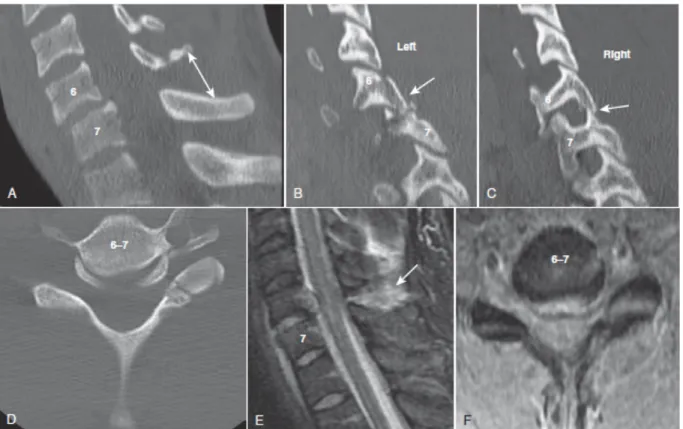 Figure 6. Modalités radiologiques démontrant un trauma médullaire secondaire à une fracture- fracture-luxation C6-C7