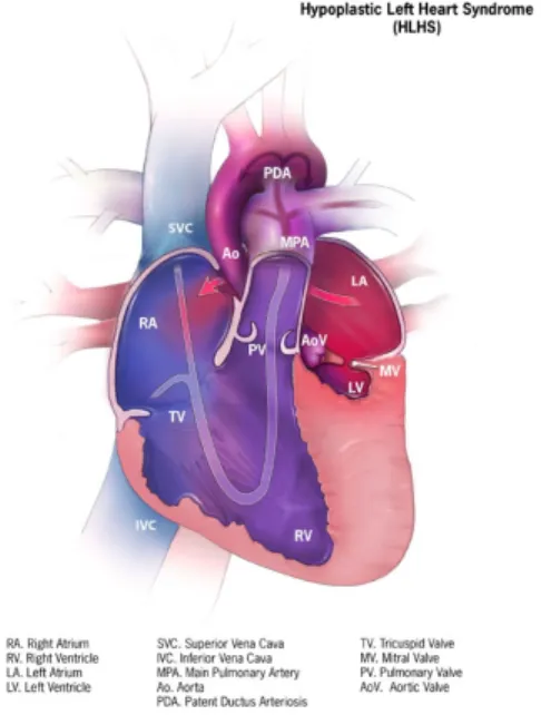Figure 4 : Diagramme d’une hypoplasie du cœur gauche. Le bleu représente du sang non- non-oxygéné