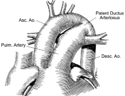 Figure 5 : Diagramme du canal artériel. Tiré de Fyler DC. Nadas' Pediatric Cardiology