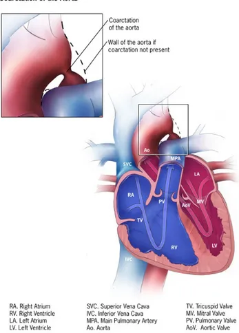 Figure 6 : Diagramme d’une coarctation de l’aorte. Le bleu représente du sang non- non-oxygéné