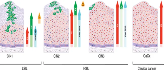 Figure  8 :  Présentation  des  changements  dans  le  profil  d’expression  de  protéines  virales,  qui  accompagnent  la  progression  vers  un  cancer  du  col  de  l’utérus  [18]