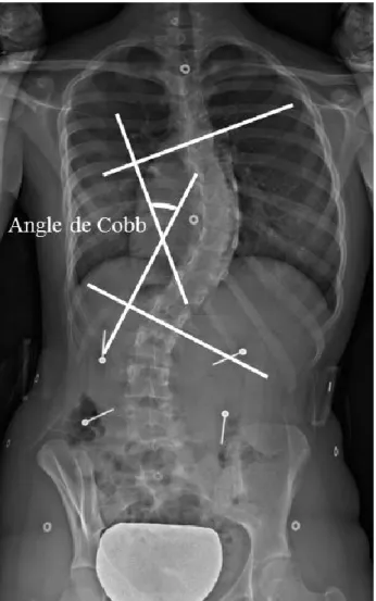 Figure  1.    Mesure  de  l’angle  de  Cobb  sur  la  radiographie  postéro-antérieure  du  dos