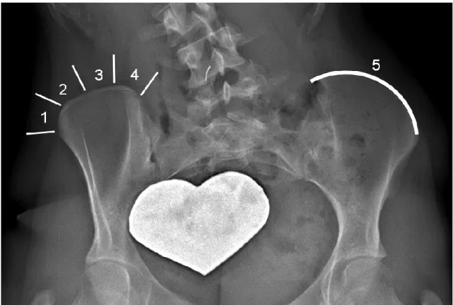 Figure 2.  Indice de Risser : degré d’apparition et d’accolement du cartilage sur la crête iliaque