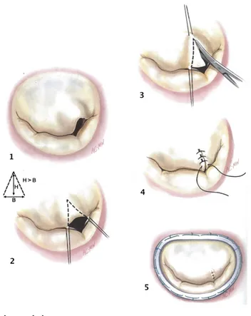 Figure 13 : Annuloplastie mitrale 
