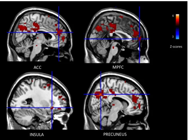 Figure 1. Negative connectivity between the left IFG and ROI activations while viewing  negative smoking-related images (relative to neutral images)