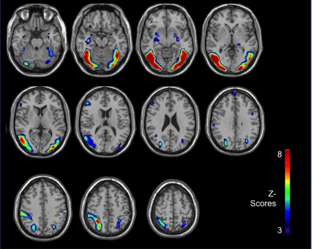 Figure 2. Brain reactivity of chronic smokers to anti-smoking images (relative to neutral)
