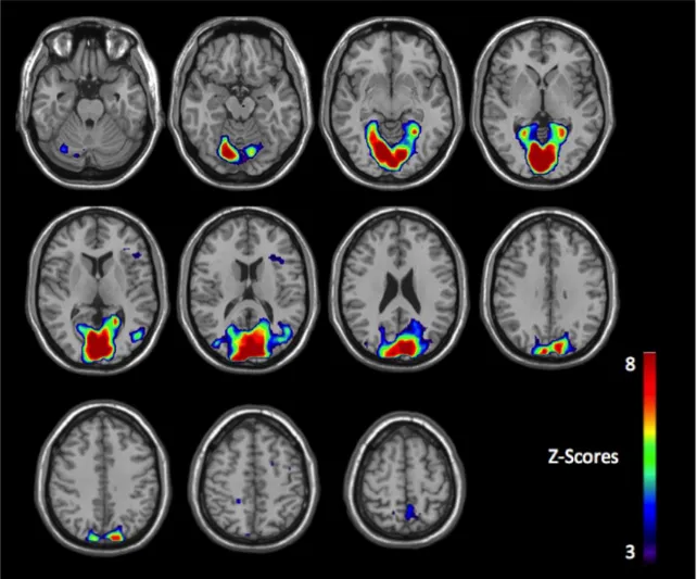 Figure 3. Brain reactivity of chronic smokers to aversive nonsmoking-related images  compared to aversive smoking-related images