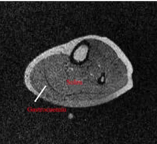 Figure 1.13 – Axial view of the calf muscle using 3T Siemens MR scanner, image taken during study.