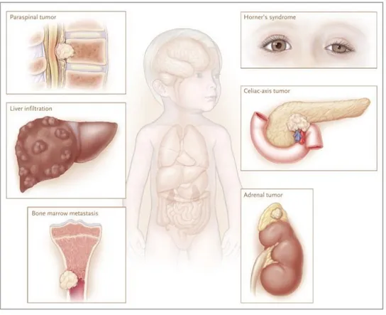 Figure 3 – Localisation et conséquences du neuroblastome 