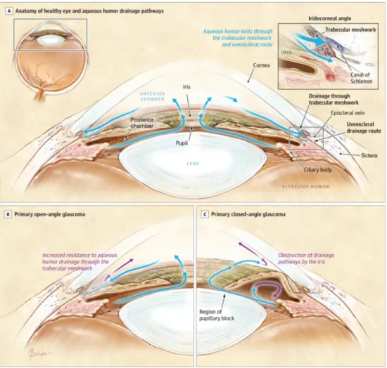 FIGURE 5. Voies de drainage de l’humeur aqueuse dans l’œil normal et l’œil  glaucomateux