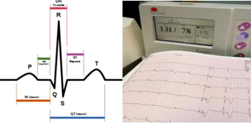Figure 2 Aspect des ondes d’un ECG normal 