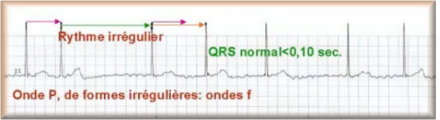 Figure 4 Fibrillation auriculaire (Rythme irrégulier) 