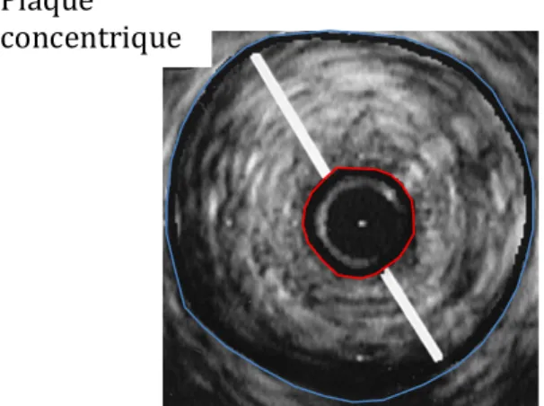 Figure	
   2B	
  :	
   Imagerie	
   intravasculaire	
   ultrasonore	
   démontrant	
   une	
   plaque	
   concentrique	
  :	
   la	
   lumière	
   du	
   vaisseau	
   est	
   située	
   à	
   l’intérieur	
   du	
   cercle	
   rouge,	
   la	
   barre	
   blanche	
   représente	
   l’épaisseur	
   de	
   la	
   plaque	
   athérosclérotique.	
   	
   On	
   remarque	
   que	
   la	
   plaque	
   est	
   plutôt	
   symétrique	
   en	
   regard	
   de	
   sa	
   distribution	
   face	
   à	
   la	
   circonférence	
   du	
   vaisseau	
  (en	
  bleu).	
  	
  Image	
  adaptée	
  de	
  Mintz	
  et	
  al.	
  Circulation	
  1996;93:924-­‐931	
  