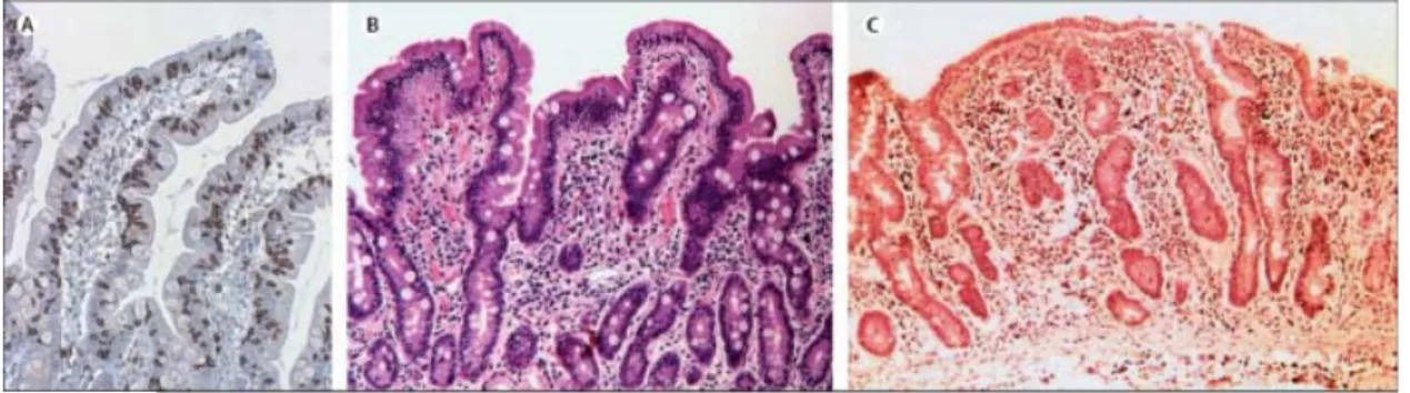 Figure 6. Grades A, B et C de la MC. Images représentatives de différents grades de  l’atteinte histologique dans la MC (79)