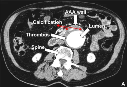 Figure 1.11 CT scan identifying the AAA lumen, wall, calcification, thrombus [79]. 