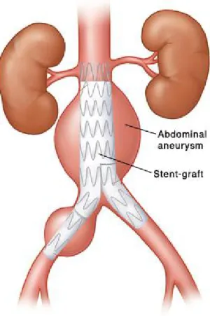 Figure 1.13 EVAR where a SG is placed inside the aneurysm without exposure of the  abdominal aorta [86]