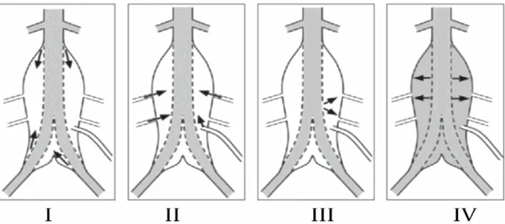 Figure 2.1 Visualization of the 4 types of endoleak. Type I: Blood flow coming from the  proximal distal neck; Type II: Collateral flow coming from the collateral arteries; Type III: A  gap in the SG leading to a blood flow inside the aneurysm sac; Type IV