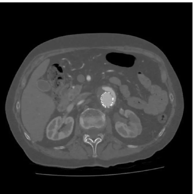 Figure 2.2 Axial CT scan image of an 80 years old female showing a type I endoleak [150]